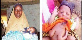 Une jeune femme met au monde un bébé avec trois jambes et quatre bras