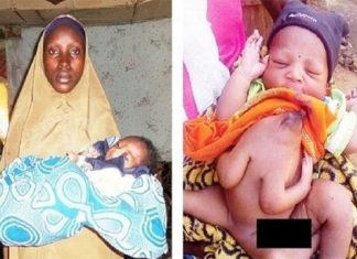 Une jeune femme met au monde un bébé avec trois jambes et quatre bras