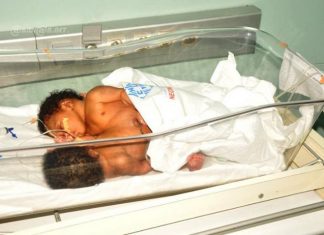 Santé : les sœurs siamoises nées au CHR de Man pourront être opérées et séparées à Abidjan