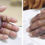 Après avoir mangé des fruits de mer crus, cet homme a dû être amputé de son bras