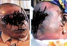 Dépigmentation : quand des femmes recherchent la beauté en dépit du danger Dépigmentation- quand- des- femmes -recherchent –la- beauté- en- dépit- du -danger