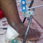 Ayouba Ag Manaou, blessé par balle de l’armée française à Intagom